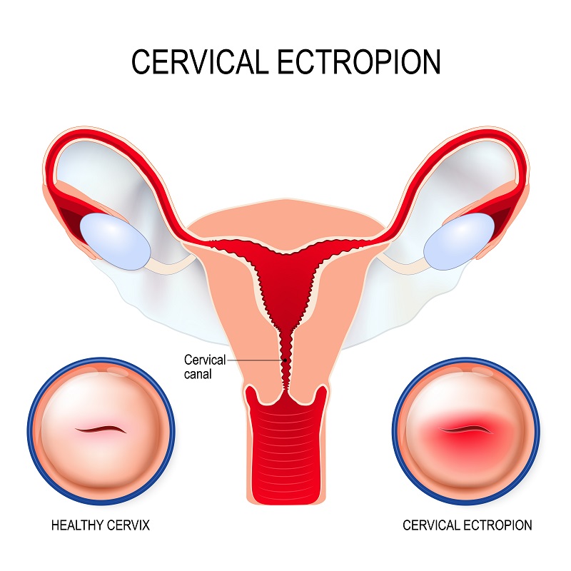 What Is A Cervical Ectropion 