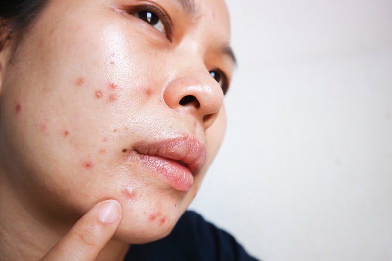 Pregnancy And Acne