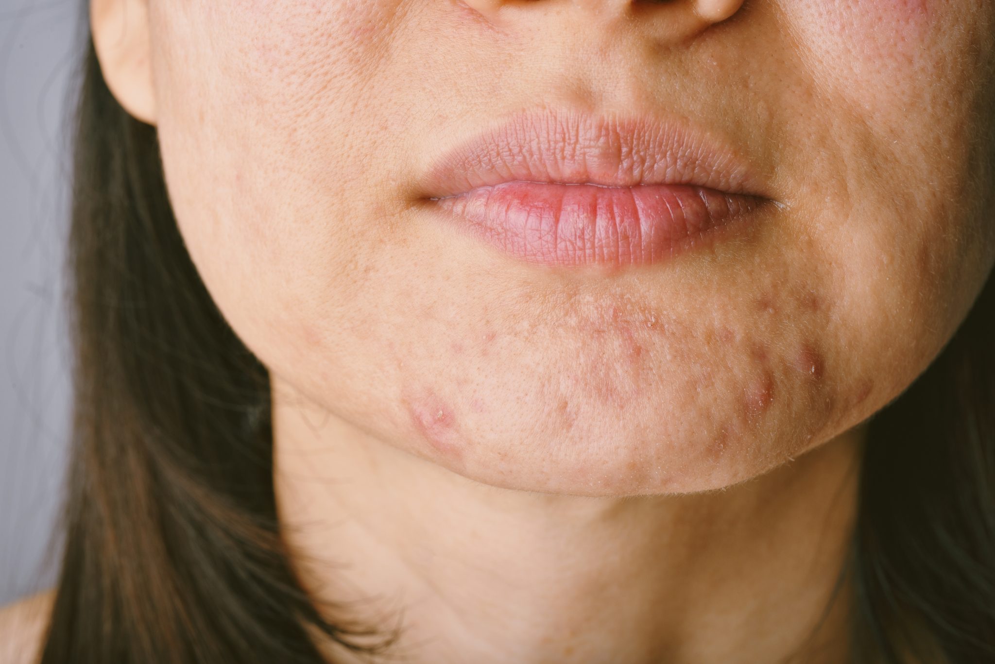 6 Ways To Manage Acne During Menopause Womens Health And Menopause Center Obgyn West 